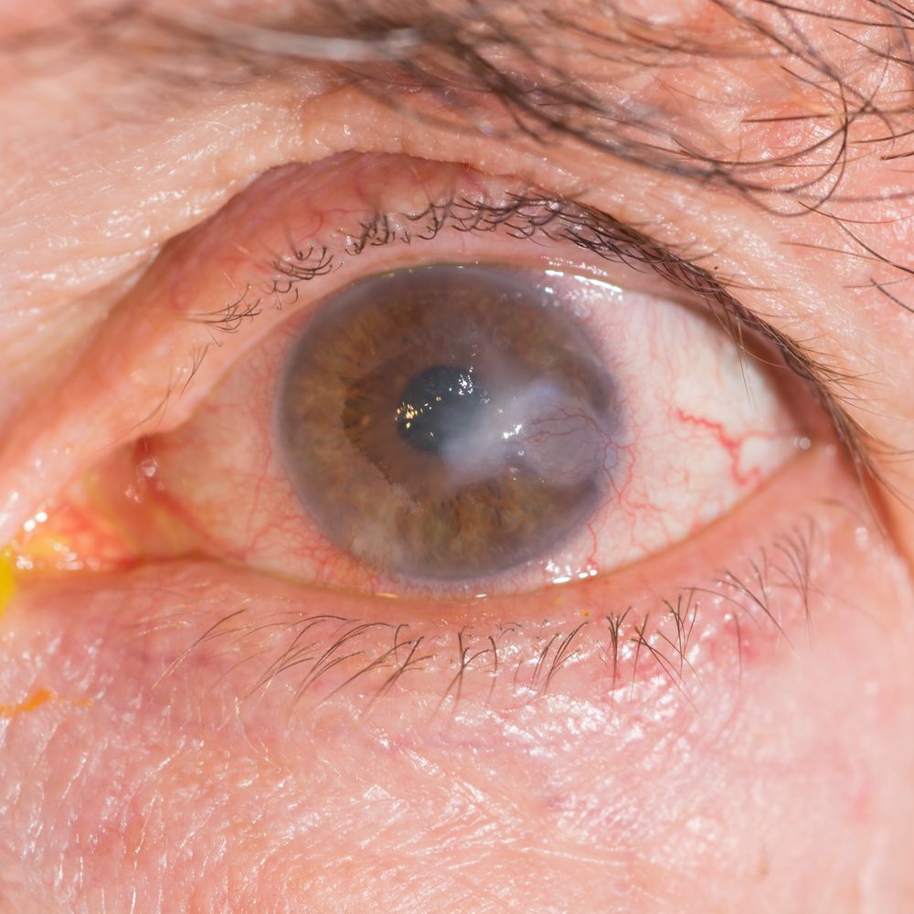 Closeup of eye affected by keratoconus